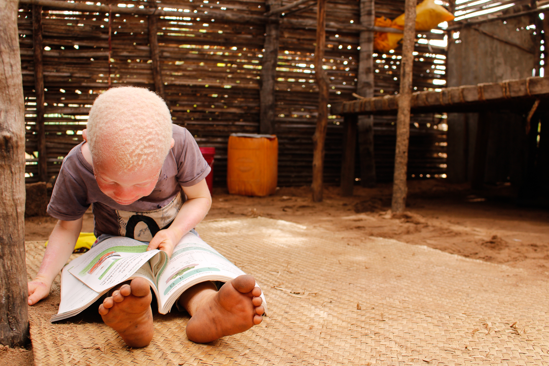 Moz-Albinism-Photo-1