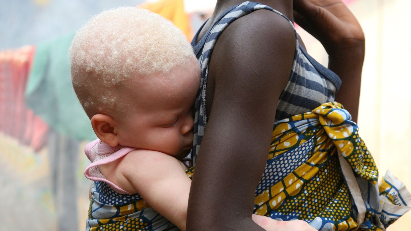 albino empowerment foundation in Nigeria 77